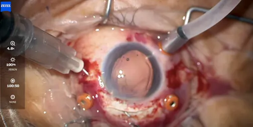 Scleral-Fixated IOL Implantation After Dislocated Lens and Retinal Detachment