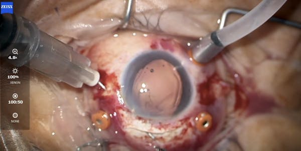 Scleral-Fixated IOL Implantation After Dislocated Lens and Retinal Detachment thumbnail