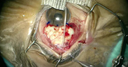 Ahmed Glaucoma Valve Implantation