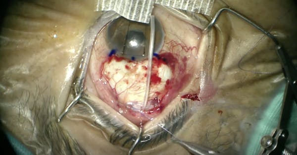 Ahmed Glaucoma Valve Implantation thumbnail