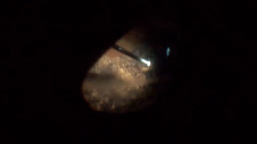 Cloudy IOL Explantation With Sutureless Scleral Fixation
