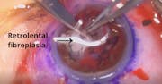 Open-Sky Vitrectomy for Advanced Stage ROP