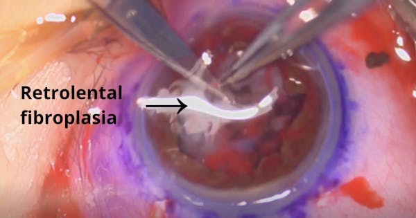 Open-Sky Vitrectomy for Advanced Stage ROP thumbnail