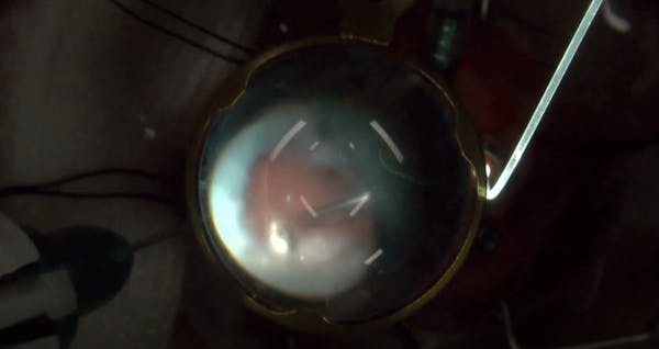 Retinal Abscess Following Intraocular Foreign Body Trauma thumbnail
