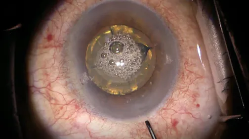 Laser Cataract Surgery