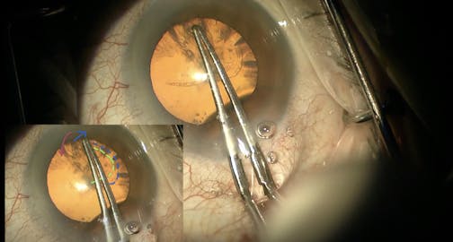 How to Manage a Capsulorrhexis Tear