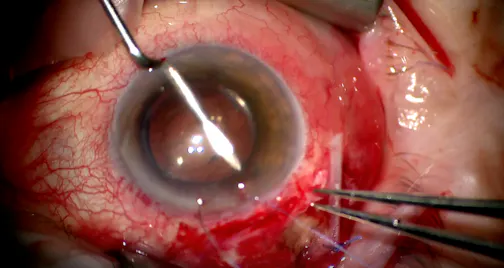 Sulcus Guidewire Technique