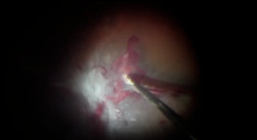 Vitrectomy for Severe Diabetic Tractional Retinal Detachment With ILM Peel