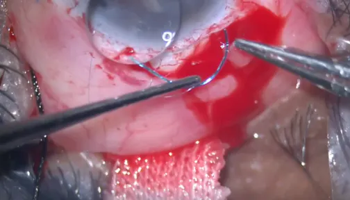 Single Haptic Iris Fixation of an IOL