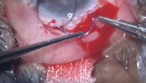 Single Haptic Iris Fixation of an IOL thumbnail