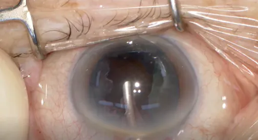 Strip Method for Cutting the Endonucleus