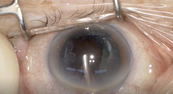 Japanese Strip Method for Cutting the Endonucleus thumbnail