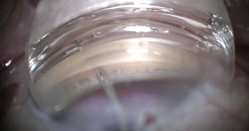 iStent Combined With Toric IOL Implantation