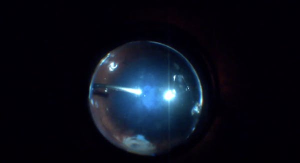 Hinged ILM Flap for Refractory Macular Hole thumbnail