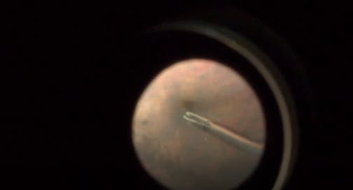 Macular Hole in Myopic Retinal Detachment