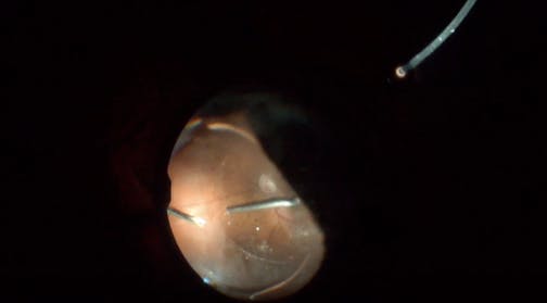 Transscleral Drainage-Assisted Vitrectomy for Retinal Detachment