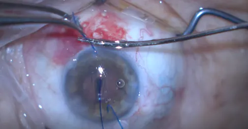 Double-Flanged Technique for Traumatic Cataract