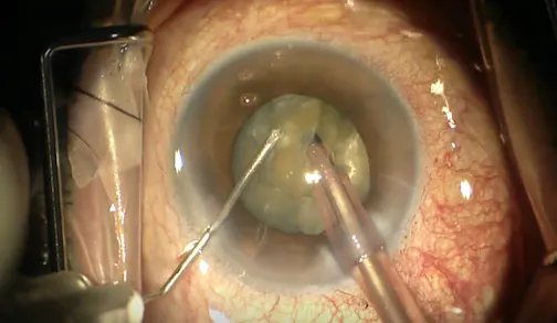 Management of a Dense Cataract
