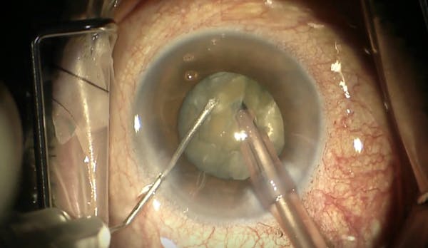 Management of a Dense Cataract thumbnail