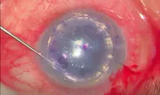 Injectable DSAEK