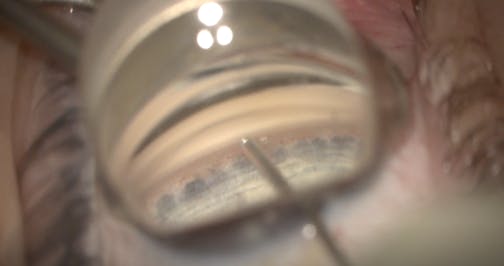 iAccess Trabecular Trephine