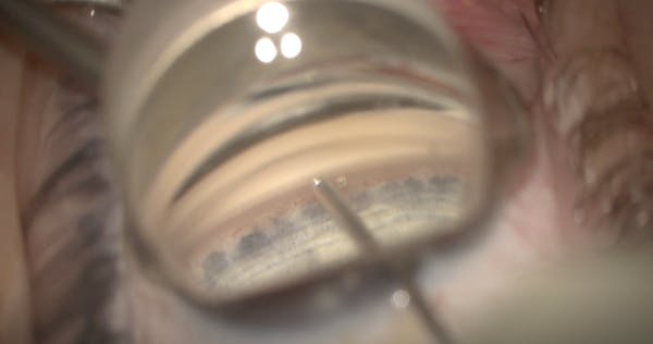 I-Access Trabecular Trephine thumbnail