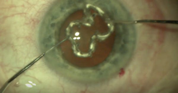 The Siepser Iris Protector Ring thumbnail