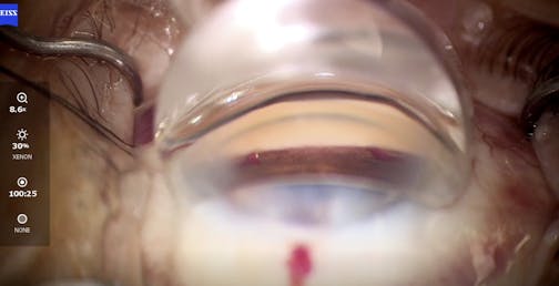 Stenting and Microgoniotomy