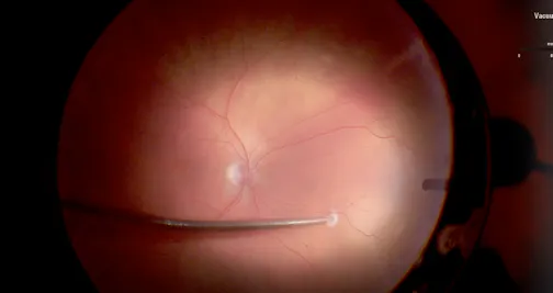 Creating a Drainage Retinotomy