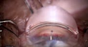 iAccess Microgoniotomy