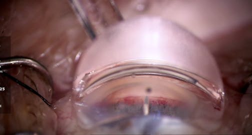 iAccess Microgoniotomy