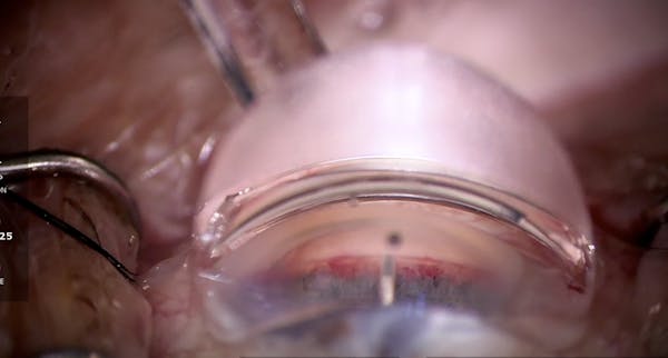 iAccess Microgoniotomy thumbnail