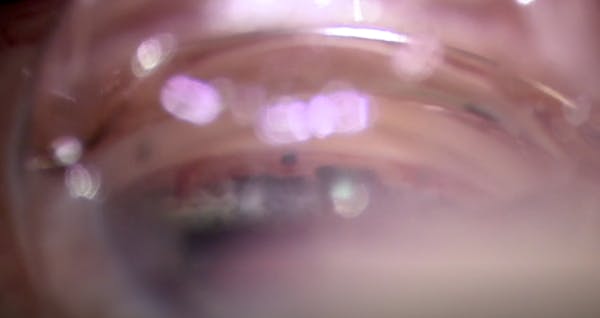 Streamline Surgical System With iStent thumbnail