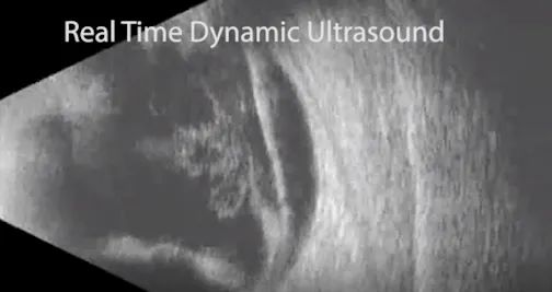 Dynamic Ultrasound of a Separated Posterior Hyaloid