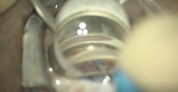 Streamline Goniotomy/Canaloplasty thumbnail
