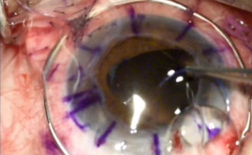 Combined Yamane and Penetrating Keratoplasty