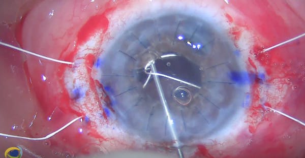 Secondary Implantation of Scleral Sutured IOL After Penetrating Keratoplasty and Pupil Cerclage thumbnail