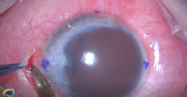 Artificial Iris and Scleral Sutured PCIOL in Posttraumatic Eye thumbnail