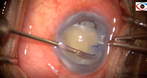 Phacoemulsification for Phacomorphic Glaucoma