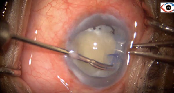 Phacoemulsification for Phacomorphic Glaucoma thumbnail