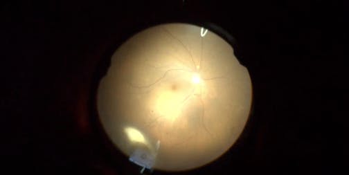 Chandelier-Assisted Scleral Buckling With Encircling PTFE Band