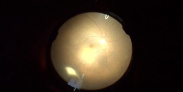 Chandelier-Assisted Scleral Buckling With Encircling PTFE Band thumbnail