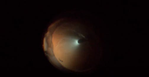 Chronic Retinal Detachment With Multifocal IOL, Hypotony, and Choroidal Detachment