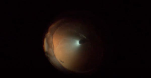 Chronic Retinal Detachment With Multifocal IOL, Hypotony, and Choroidal Detachment thumbnail