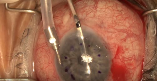 Standard Approach for DSAEK Surgery