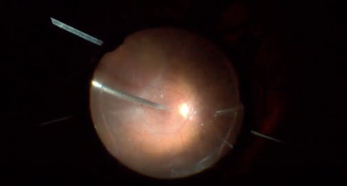 Retinal Detachment With Stickler Syndrome