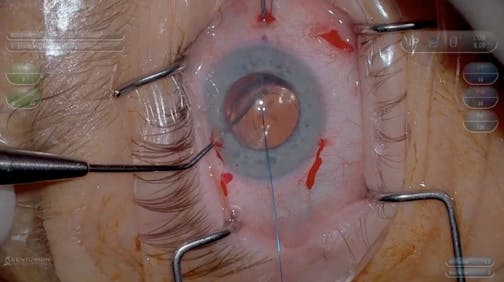 McCabe Belt Loop Technique