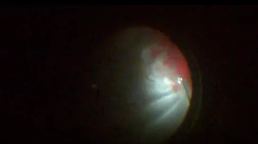 Complex Retinal Detachment From Ocular Trauma