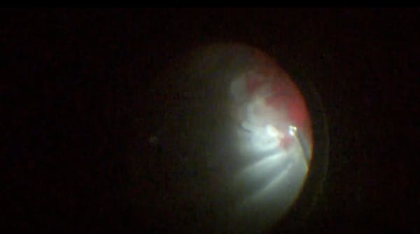 Complex Retinal Detachment From Ocular Trauma thumbnail