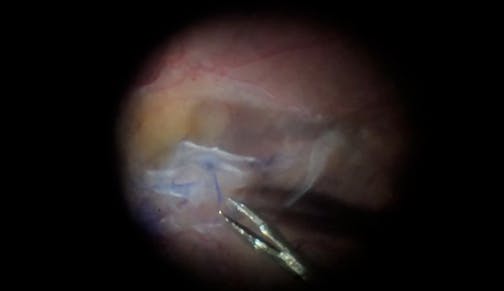 Double Stain With Brilliant Blue for Taut Macular Pucker